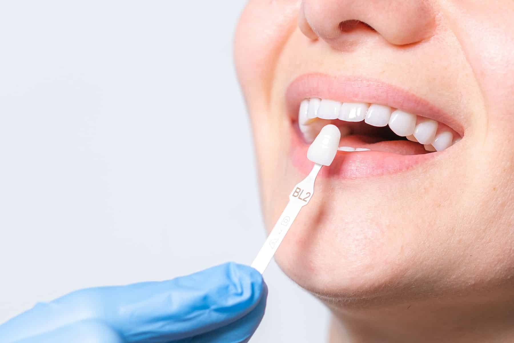 Veneers dentist in Grand Bay, AL